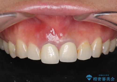 [抜歯時の顎堤保存]  審美的なブリッジ製作の症例 治療前