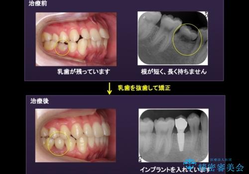 すきっ歯・出っ歯が気になる インビザライン矯正 乳歯をインプラントにの治療前