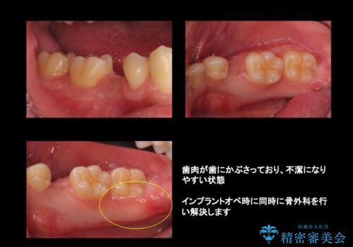 20代男性　奥歯のインプラント　自分の骨を移植の症例 治療前