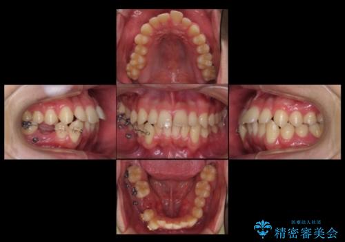 すきっ歯・出っ歯が気になる インビザライン矯正 乳歯をインプラントにの治療中
