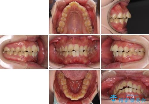 口元の突出感を改善 ワイヤー装置による抜歯矯正の治療前