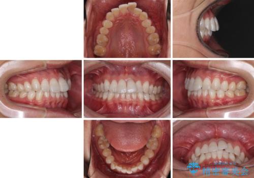 前歯のデコボコを治したい インビザラインによる矯正治療の治療前