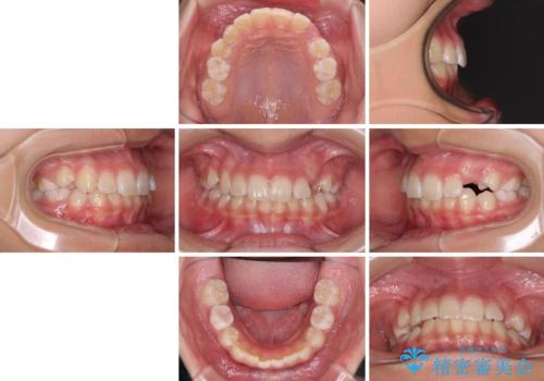 埋もれた犬歯を引っ張り出す 小学生のⅠ期治療の治療前