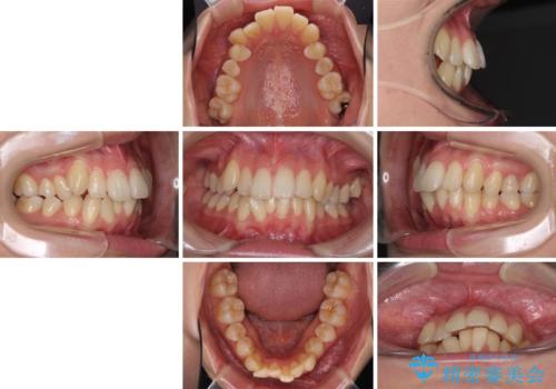 インビザラインでスッキリとした口元にの治療前