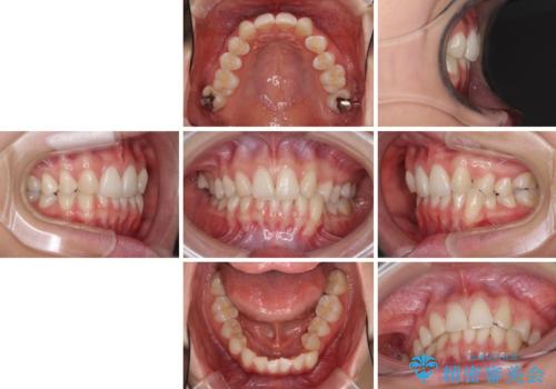上顎前歯が2本欠損　インビザラインによる叢生の解消の治療前