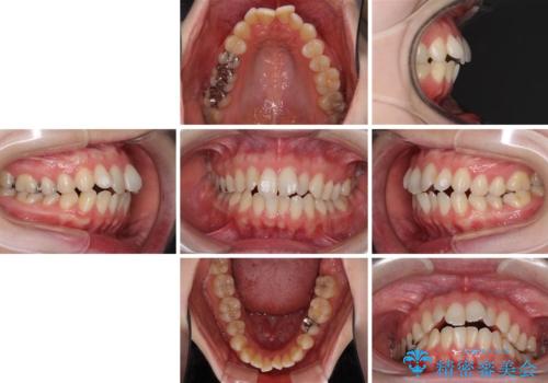 前歯のデコボコを改善　目立たないワイヤー矯正の治療前