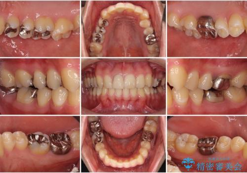 銀歯を白くしたい セラミックによる審美歯科治療の治療前