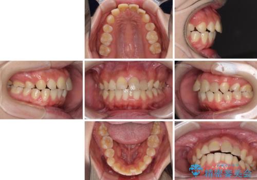 抜歯矯正の後戻り インビザラインによるオープンバイトの再矯正の治療前