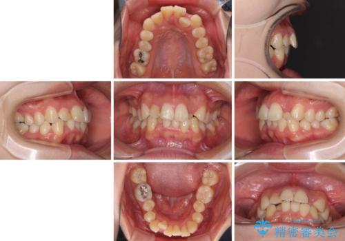 短期間で終了 デコボコをワイヤー矯正で解消の治療前