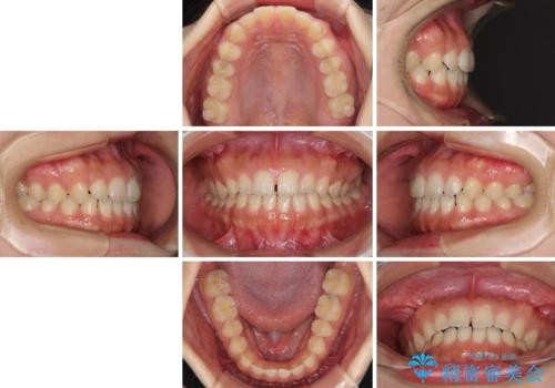 気になる隙間の再矯正 前歯をインビザライン・ライトで改善の治療前