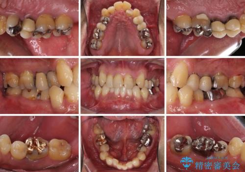 歯列不正と歯周病 総合歯科治療による全顎治療の治療前
