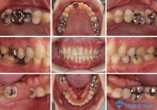 気になる部分を全て治療　総合歯科治療で口腔内環境改善の治療前