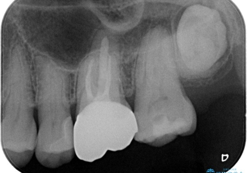金属をセラミックにしたい、根管治療も行ったケースの治療後