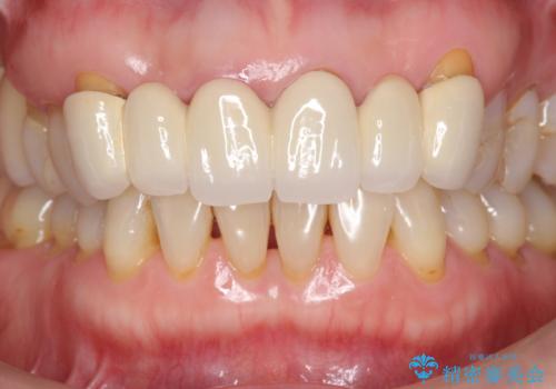 不自然な前歯ブリッジ ジルコニアブリッジによるやり替えの治療前