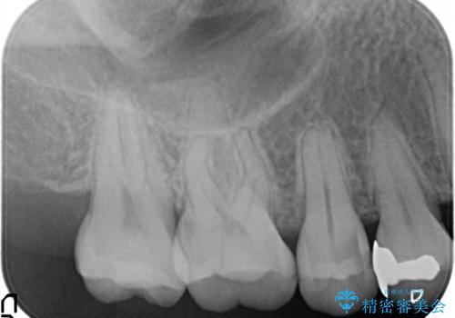 【セラミックインレー】むし歯の治療の治療前