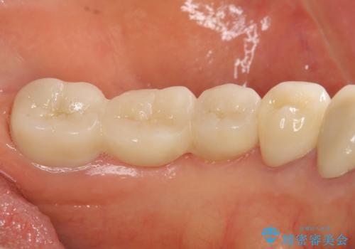 清掃しづらく、見た目の気になるブリッジの治療後