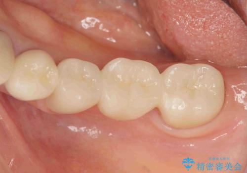 清掃しづらく、見た目の気になるブリッジの治療後