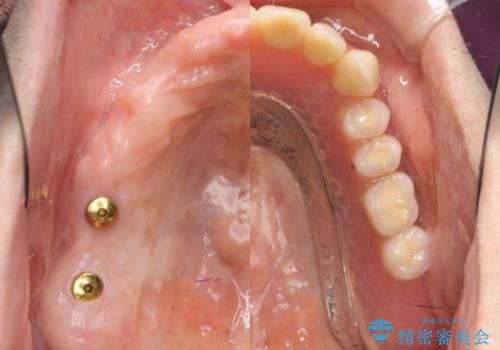 「しっかり噛める入れ歯」インプラントオーバーデンチャー