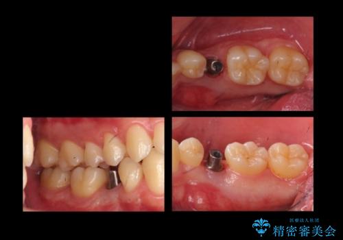 20代男性 奥歯のインプラント 自分の骨を移植の治療中