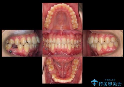 すきっ歯・出っ歯が気になる インビザライン矯正 乳歯をインプラントにの治療中