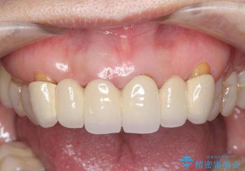 不自然な前歯ブリッジ ジルコニアブリッジによるやり替えの治療前