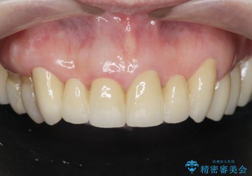 不自然な前歯ブリッジ ジルコニアブリッジによるやり替え