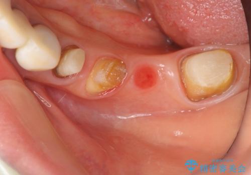 清掃しづらく、見た目の気になるブリッジの治療中