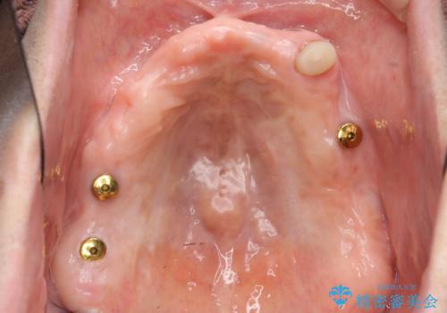 「しっかり噛める入れ歯」インプラントオーバーデンチャーの治療中