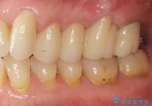 歯ぎしりに抵抗する歯周補綴 インプラント補綴の治療後