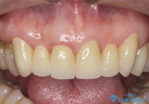 不自然な前歯ブリッジ ジルコニアブリッジによるやり替えの治療後