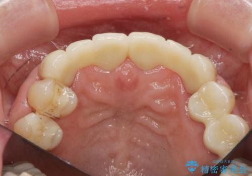 不自然な前歯ブリッジ ジルコニアブリッジによるやり替えの治療後