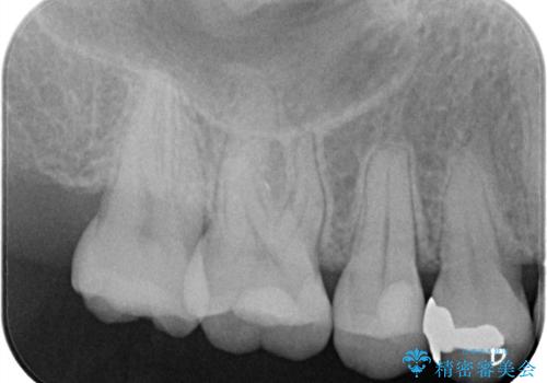 【セラミックインレー】むし歯の治療の治療後