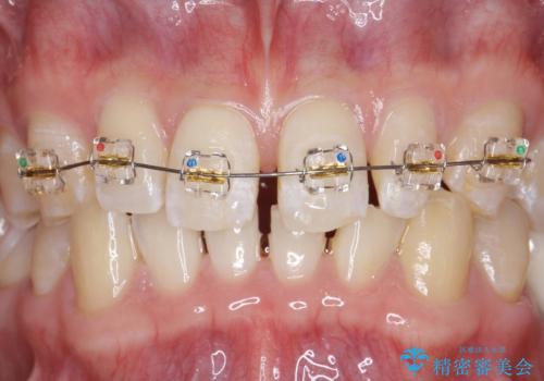 オールセラミッククラウン 部分矯正の治療中