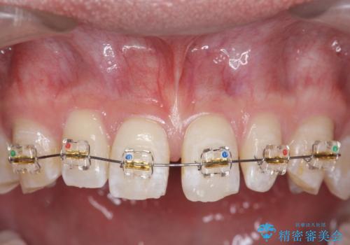 オールセラミッククラウン 部分矯正の治療中