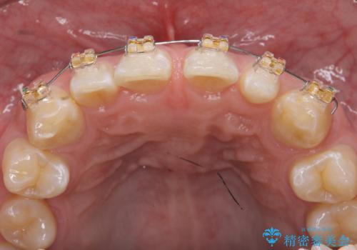 オールセラミッククラウン 部分矯正の治療中