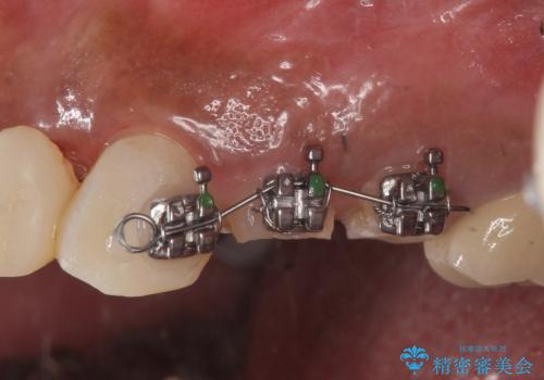 オールセラミッククラウン 根管治療のやり直しの治療中