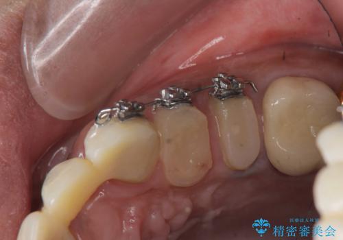 オールセラミッククラウン 根管治療のやり直しの治療中