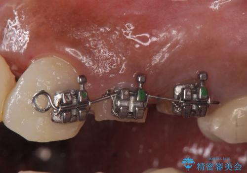 オールセラミッククラウン 根管治療のやり直し