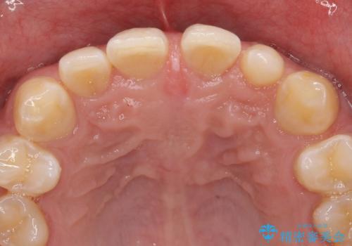 オールセラミッククラウン 部分矯正の治療前