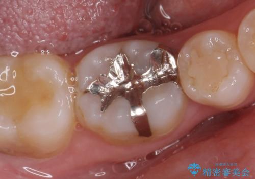 セラミックインレー　銀歯から白い歯への治療前