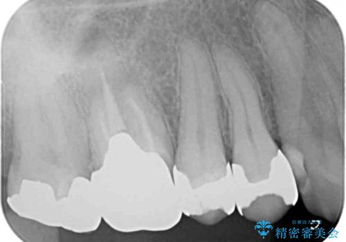 痛くてかめない 根管治療とオールセラミッククラウンの治療前