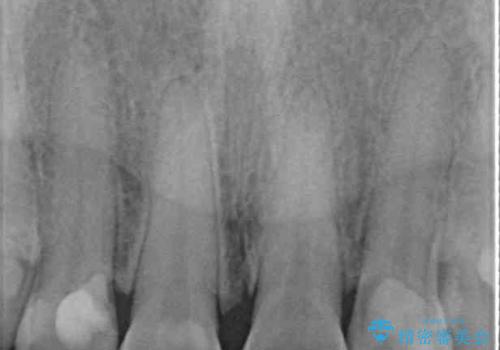 欠けてガタガタの前歯 オールセラミッククラウンによる補綴治療の治療前