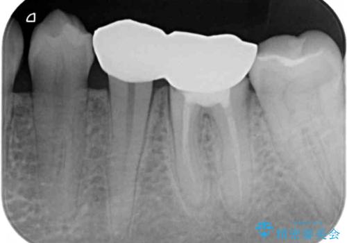 深い虫歯で歯茎が腫れる　部分矯正を用いたむし歯治療の治療前