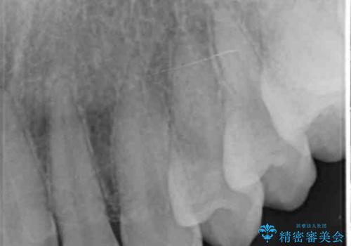 割れにくいセラミック治療 フルジルコニアクラウンの治療前