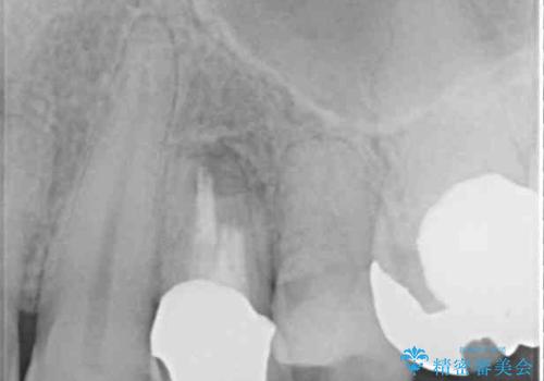 割れてしまった小臼歯 インプラントによる補綴治療の治療前