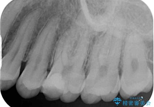他院で神経を取ると言われた 神経を極力残した虫歯治療の治療前