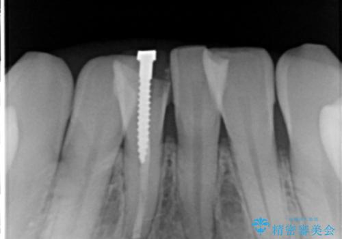 下の前歯の色が気になる セラミックで綺麗に 40代男性の治療前