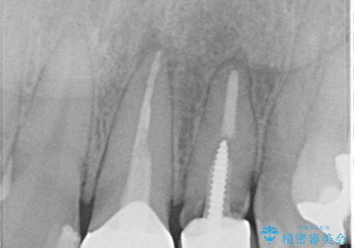 外れそうで不適合のかぶせ物の根管治療からの再治療の治療前