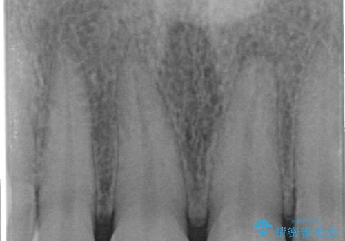 歯が折れた セラミックで綺麗に 30代女性の治療前