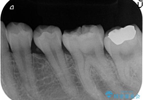 オールセラミッククラウン 知覚過敏の治療の治療前